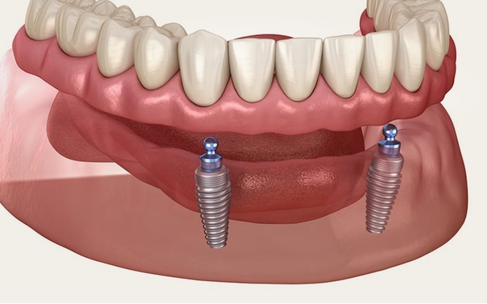 Implants dentaires